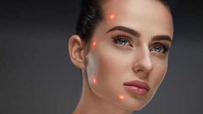 Ce este întinerirea fracționată a pielii