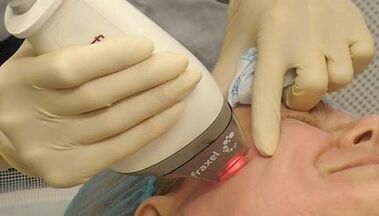 Cum se realizează întinerirea fracționată a pielii