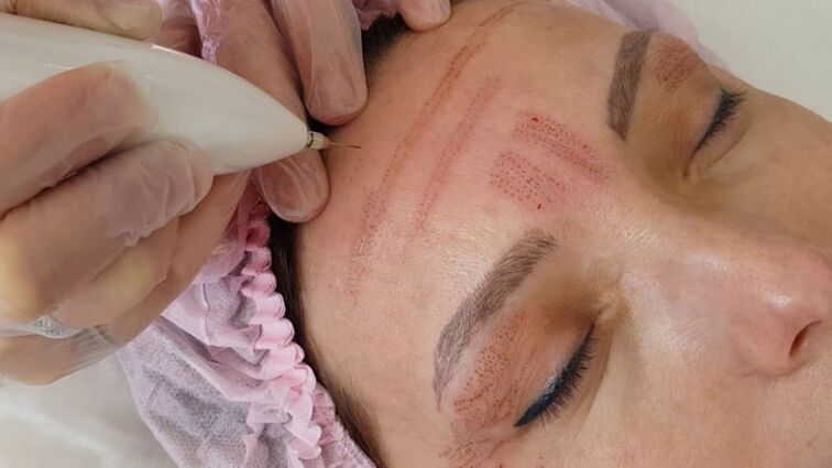 Întinerirea facială cu plasmă
