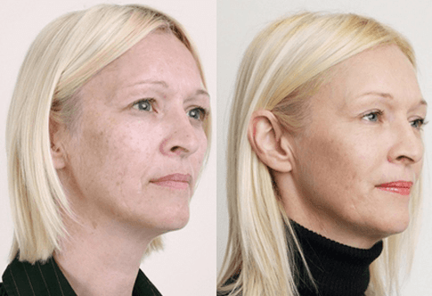 Peeling mediu cu acizi din fructe