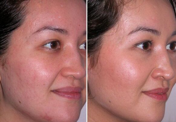 curs de microdermabraziune