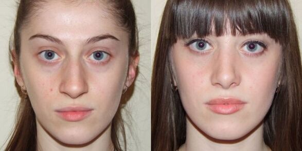 Fată înainte și după întinerirea pielii faciale cu plasmă