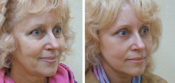 Femeie înainte și după întinerirea pielii faciale cu plasmă